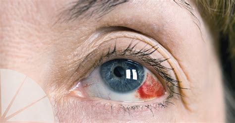 hemorragia ocular - ceratite ocular